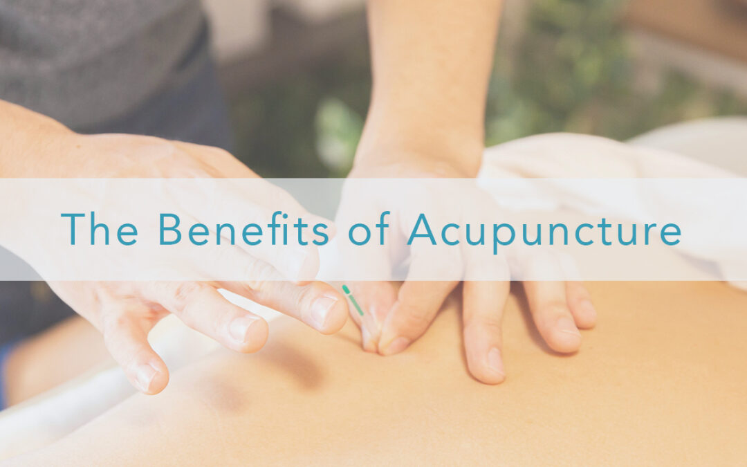 Benefits of Acupuncture