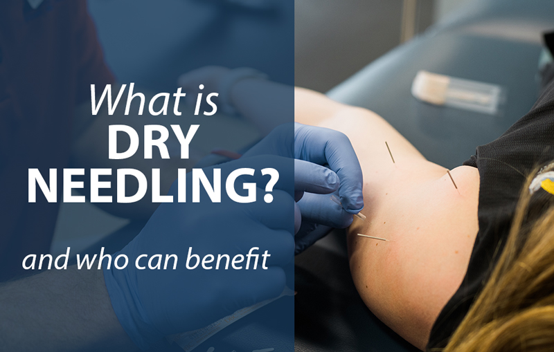 What is Dry Needling and who can benefit June blog